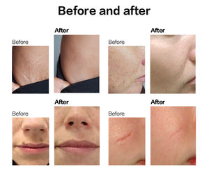 Macchina per Resurfacing Cutaneo con Laser <span class=keywords><strong>CO2</strong></span> Frazionato a Prezzo di Fabbrica, per Rimozione Rughe, Terapia dell'Acne e Rassodamento Vaginale - Product Image 6