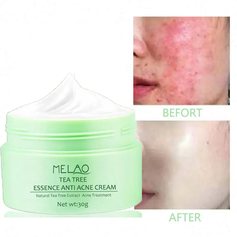best green tea oem anti-acne remove a acne melasma pimple treatment scar root rose cream for acne treatment cream korea