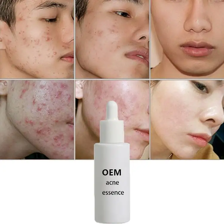 Private Label Organic Face Anti Acne Whitening Cream brufolo Acne Scar Removal vitamina C Acne Treatment