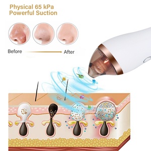 Dispositivo Eléctrico de Succión para la Eliminación de Puntos Negros, Limpiador Facial, Productos de Belleza para el Cuidado Facial, Diseño OEM/ODM - Product Image 4