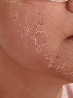 ZS efficace Spongilla Spicules Biomicroneedling algues Peeling poudre d'éponge hydrolysée pour l'acné Melasma Hyperpigmentation