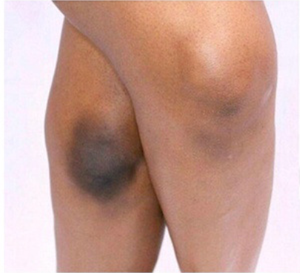 Crema Exfoliante para Eliminar <span class=keywords><strong>Cicatrices</strong></span> Antiguas en las Piernas, <span class=keywords><strong>Aceite</strong></span> Blanqueador para la Piel - Product Image 2