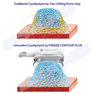 Cryalipolysis máquina de adelgazamiento de china nuevo producto innovador - Product Image 2
