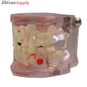 Claire dentaire D'âges Mixtes Modèle de Dentition avec Caries - Product Image 1