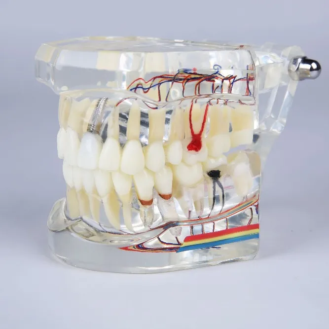 Neue design Implantat & restaurierung dental modell mit nerven für demonstration endo ausbildung