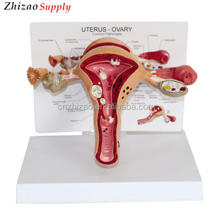 Anatómicos humanos útero patológico modelo - Product Image 1