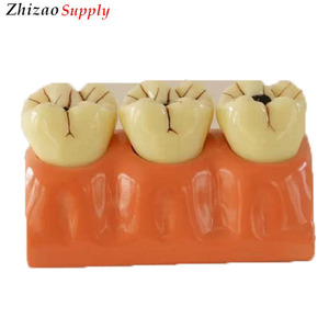 4 fois Dentaire Caries Démonter Dents Modèle Anatomique - Product Image 1