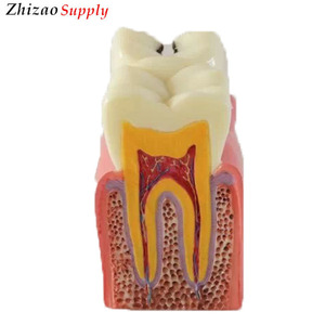 6 fois Caries Dentaires Comparaison Modèle Pathologie Humaine Modèle de Dents - Product Image 1