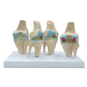 4 Delen Menselijk Plastic Ziek Knieskeletmodel, 4-traps Menselijk Kniegewrichtsmodel - Product Image 1