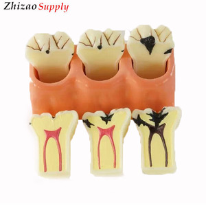 4 fois Dentaire Caries Démonter Dents Modèle Anatomique - Product Image 2