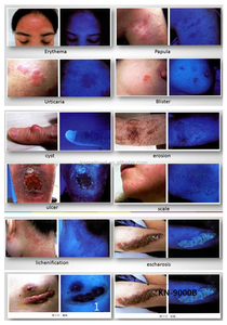 Kn-9000b lâmpada médica veterinária, teste de pele e diagnóstico de luz dermatológica de madeira com uba & luz led - Product Image 4