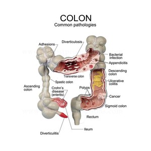 Modelo de Colon para Patología, Órganos del <span class=keywords><strong>Cuerpo</strong></span> <span class=keywords><strong>Humano</strong></span>, Anatomía - Product Image 4