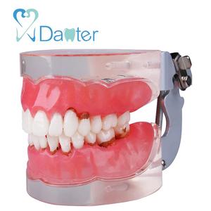 Gigi Periodontal Model dengan Penggantian Gingivitis Gigi Model Pengajaran - Product Image 2