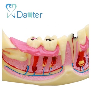 Modelo de Mandíbula Más Vendido para Mostrar Impactos, Caries y Abscesos - Product Image 4