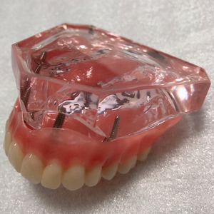 Educativi Superiore Mandibola Modello di Impianto Denti Overdenture Modello con 4 impianti - Product Image 2