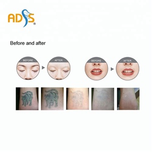 ADSS Nd Yag Laser Tattoo Removal Giá Máy - Product Image 5