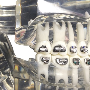 022 tubi buccali ortodonzia dentale - Product Image 5