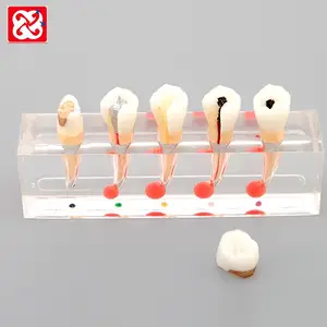 Dental study Model endodontic treatment process dental model patient education model