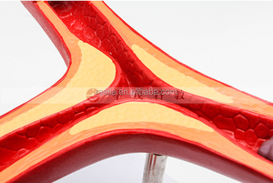 HM-BD-082 Aterosklerosis Model Anatomi Aterosklerosis Model Anatomi Medis Aterosklerosis Model - Product Image 5