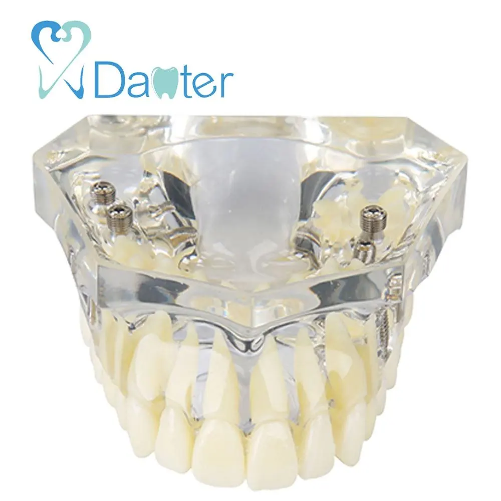 2018 best sale dental maxillary model with implant for dental college student
