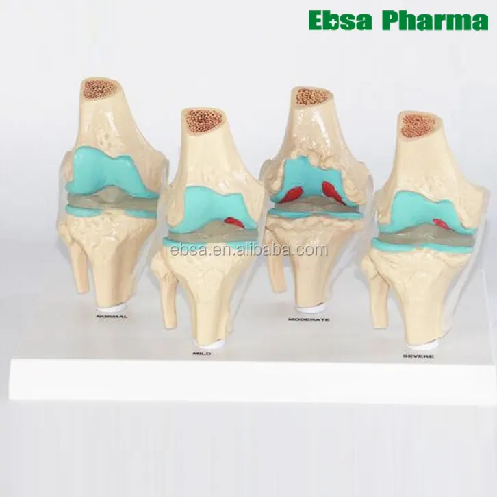 3D Anatomía Humana gráfico de 4-etapa la osteoartritis cartel