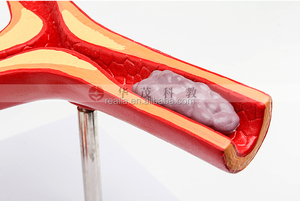 HM-BD-082 Aterosklerosis Model Anatomi Aterosklerosis Model Anatomi Medis Aterosklerosis Model - Product Image 6