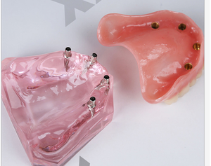 Bovenkaak Overkappingsprothese Restauratie Model Met 4 Implantaten Prothese Model - Product Image 4