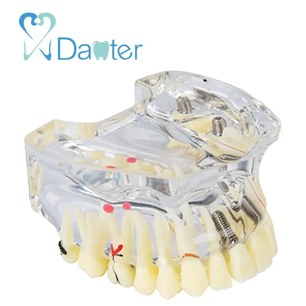 Precio atractivo modelo Dental de los dientes con la restauración y implante