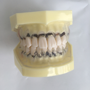 Zahn modell mit peroidonaler Erkrankung und transparentem klarem Zahnfleisch demos trates Ginivae-Rezession - Product Image 1