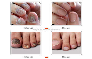 OMYLADY Soin des ongles antifongique blanchissant à base de plantes pour pieds et ongles, <span class=keywords><strong>traitement</strong></span> des mycoses des ongles 10ml – Meilleure vente sur le marché international - Product Image 4