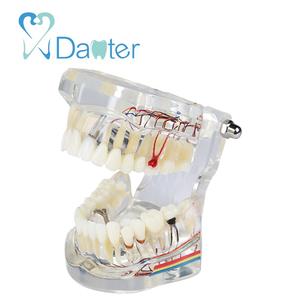 A200-2 All in one Dental Implant Model met Zenuw en Verwisselbare Tanden kroon bruggen - Product Image 2