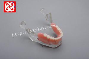 Gigi Tiruan Implan dan Pemulihan Anatomi Rahang Model - Product Image 2