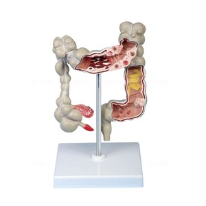 Modelo de Colon para Patología, Órganos del <span class=keywords><strong>Cuerpo</strong></span> <span class=keywords><strong>Humano</strong></span>, Anatomía - Product Image 2