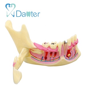 Modelo de Mandíbula Más Vendido para Mostrar Impactos, Caries y Abscesos - Product Image 1