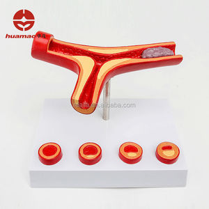 HM-BD-082 Aterosklerosis Model Anatomi Aterosklerosis Model Anatomi Medis Aterosklerosis Model - Product Image 2