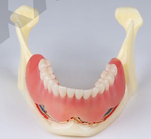 Denture implante e restauração modelo de mandíbula anatômica