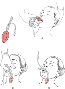 CE & ISO Certified Reutilizável Silicone Laríngea Máscara Médica Alta Qualidade Consumíveis Médicos - Product Image 6