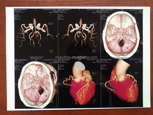 <span class=keywords><strong>Film</strong></span> radiographique médical opaque blanc pour impression d'images sur imprimante jet d'encre Epson et Canon - Product Image 3