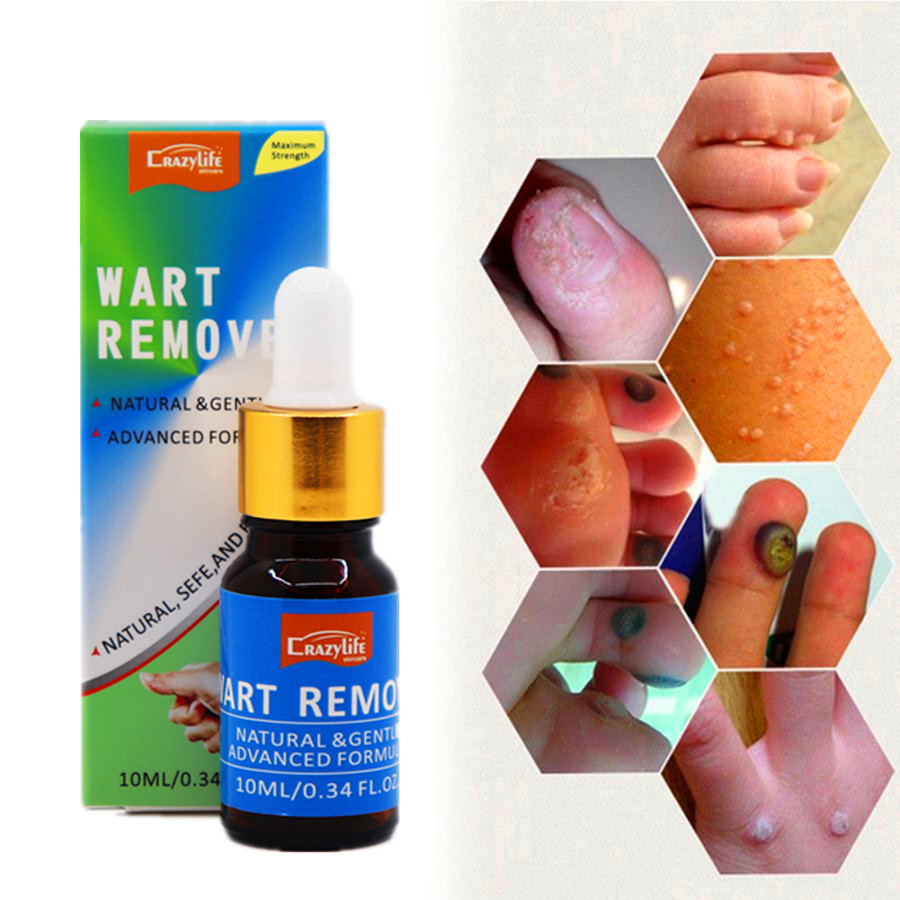 Средство для удаления родинок, бородавок, мозолей, черных точек, 10 мл