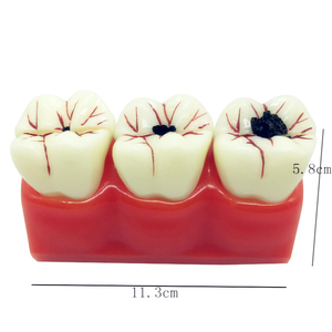 Modello dentale patologico 4 volte rimovibile carie dente anatomia dentale educazione denti modello di decomposizione carie modello