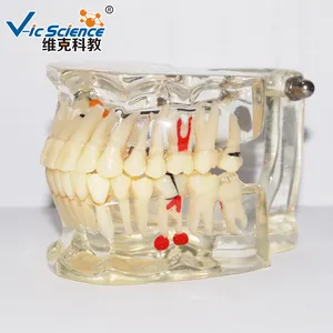 Pathology Implant Medical Dental Education Teeth Tooth Model