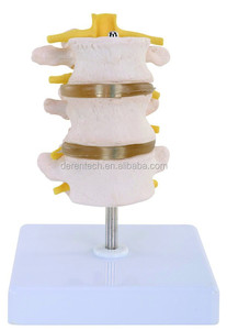 Vértebras lumbares con <span class=keywords><strong>hernia</strong></span> y <span class=keywords><strong>disco</strong></span> intervertebral sobresaliente Producto <span class=keywords><strong>de</strong></span> ciencia médica - Product Image 6