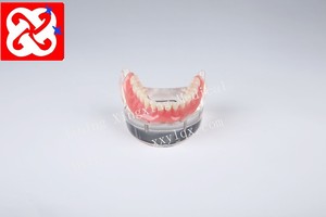 Onderkaak overkappingsprothese implant tanden model met 4 implantaten
