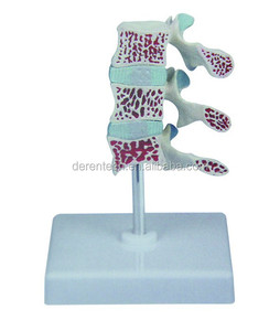 Vértebras lumbares con <span class=keywords><strong>hernia</strong></span> y <span class=keywords><strong>disco</strong></span> intervertebral sobresaliente Producto <span class=keywords><strong>de</strong></span> ciencia médica - Product Image 4