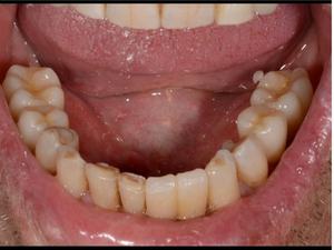 치과 실험실/공장 지르코니아 세라믹 블록/<span class=keywords><strong>CAD</strong></span> 캠 - Product Image 4