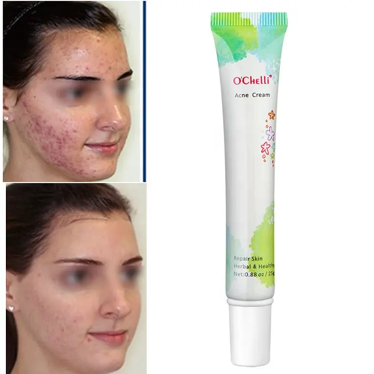 Crème Elica pour vous rendre belle, contrôle de sébum, traitement de l'acné, 1 jour