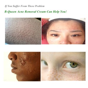 Crème pour éliminer les taches brunes du visage Crème pour éliminer les taches brunes - Product Image 2