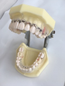 Zahn modell mit peroidonaler Erkrankung und transparentem klarem Zahnfleisch demos trates Ginivae-Rezession - Product Image 3