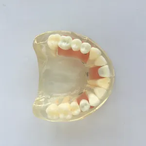 Diş İmplant modeli üst diş modeli gösterir abutment yumuşak sakız ve köprü