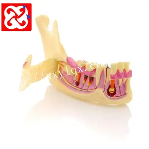 치과 study mandible 박힘 우식증 및 농양 model 환자 교육 model